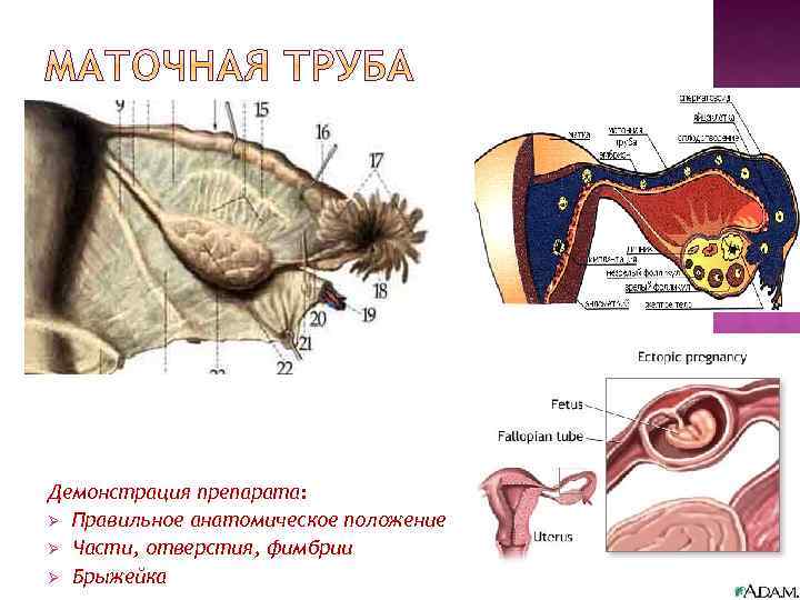 Перекрут придатков матки презентация