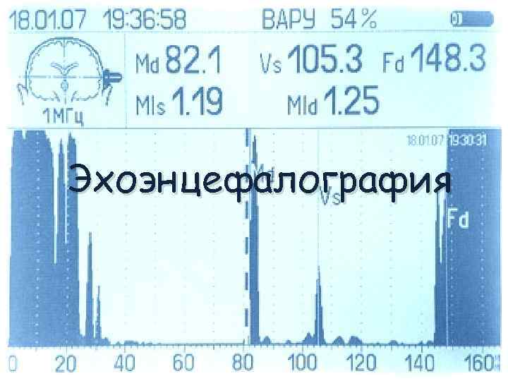 Эхоэнцефалография 