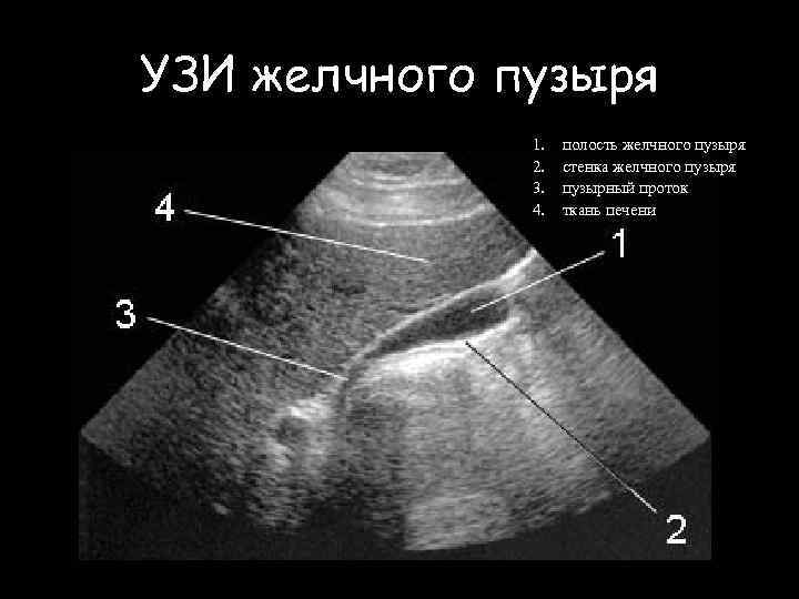 УЗИ желчного пузыря 1. 2. 3. 4. полость желчного пузыря стенка желчного пузыря пузырный