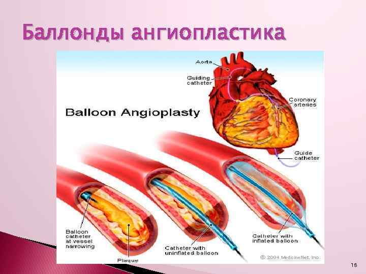 Баллонды ангиопластика 18 