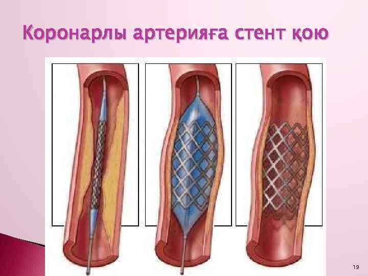 Коронарлы артерияға стент қою 19 