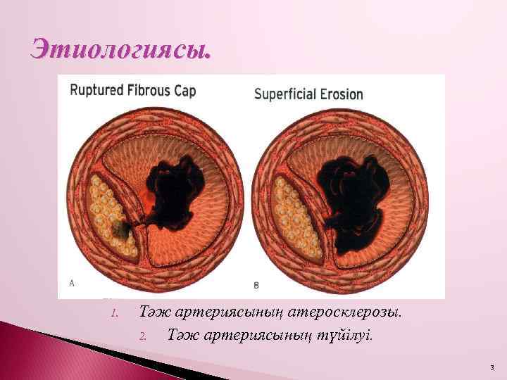 Этиологиясы. 1. Тәж артериясының атеросклерозы. 2. Тәж артериясының түйілуі. 3 