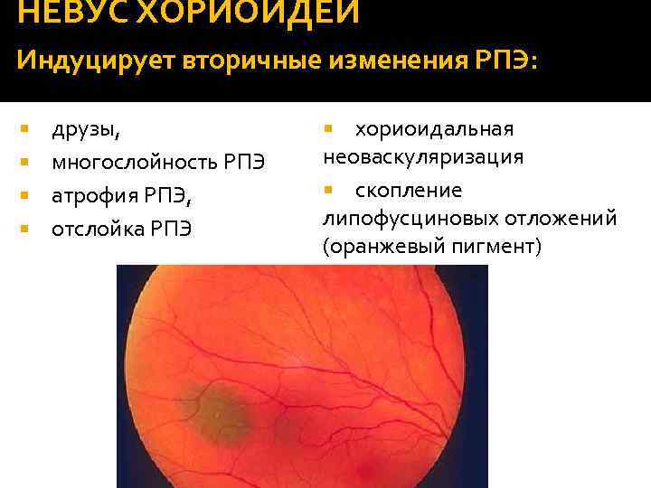 НЕВУС ХОРИОИДЕИ Индуцирует вторичные изменения РПЭ: друзы, многослойность РПЭ атрофия РПЭ, отслойка РПЭ хориоидальная