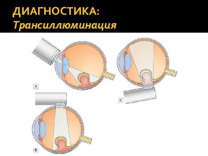 ДИАГНОСТИКА: Трансиллюминация 