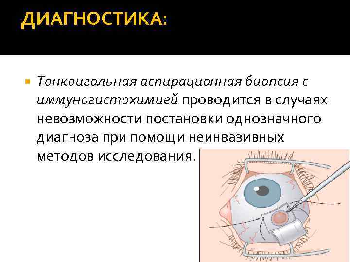 ДИАГНОСТИКА: Тонкоигольная аспирационная биопсия с иммуногистохимией проводится в случаях невозможности постановки однозначного диагноза при