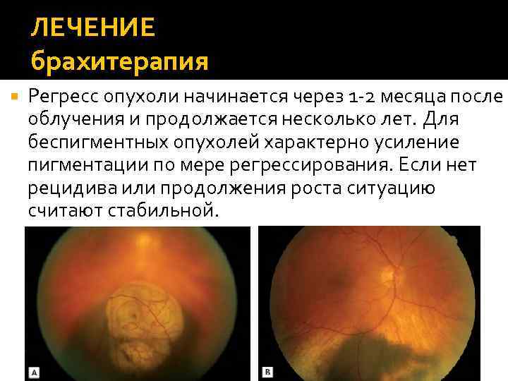 ЛЕЧЕНИЕ брахитерапия Регресс опухоли начинается через 1 -2 месяца после облучения и продолжается несколько