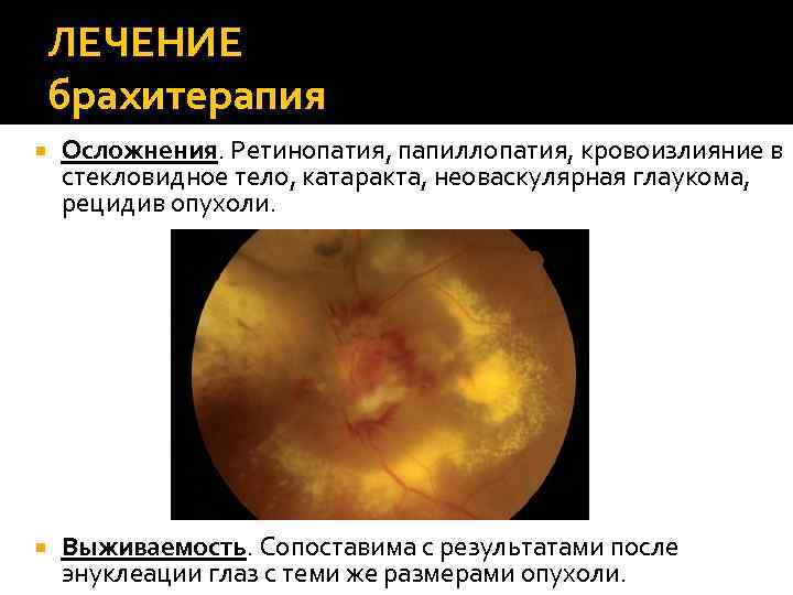 ЛЕЧЕНИЕ брахитерапия Осложнения. Ретинопатия, папиллопатия, кровоизлияние в стекловидное тело, катаракта, неоваскулярная глаукома, рецидив опухоли.