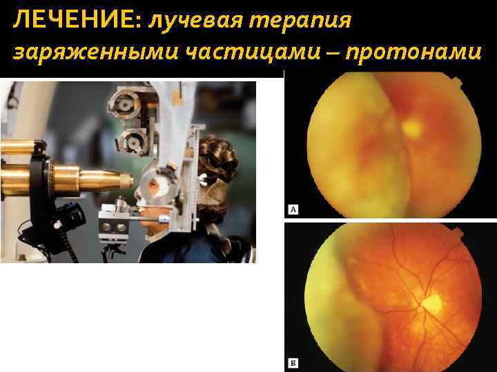 ЛЕЧЕНИЕ: лучевая терапия заряженными частицами – протонами 