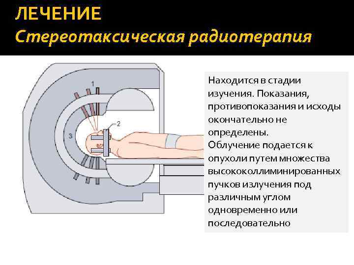 ЛЕЧЕНИЕ Стереотаксическая радиотерапия Находится в стадии изучения. Показания, противопоказания и исходы окончательно не определены.