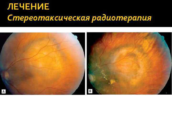 ЛЕЧЕНИЕ Стереотаксическая радиотерапия 