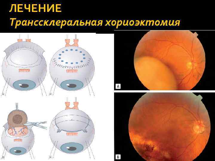 ЛЕЧЕНИЕ Транссклеральная хориоэктомия 