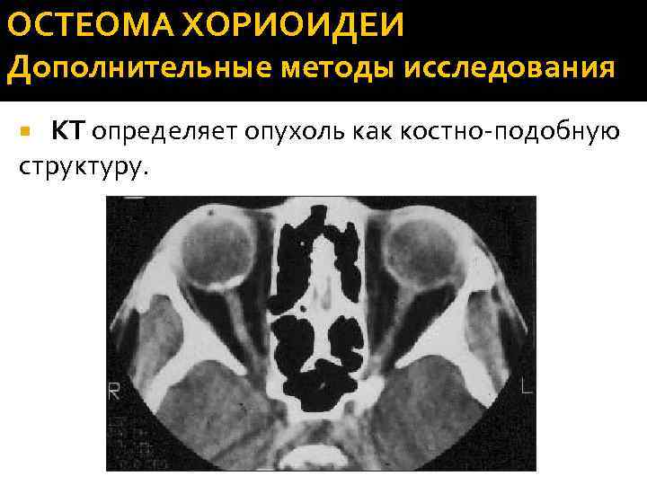 ОСТЕОМА ХОРИОИДЕИ Дополнительные методы исследования КТ определяет опухоль как костно-подобную структуру. 