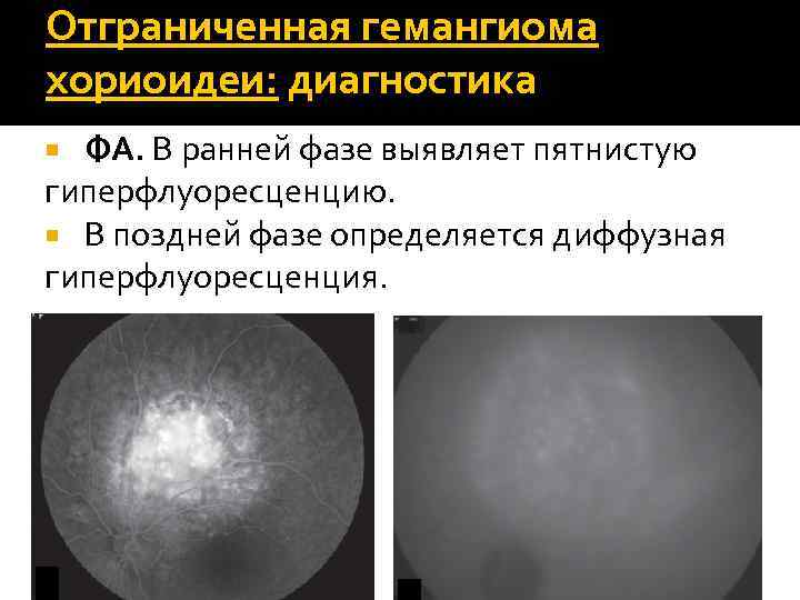 Отграниченная гемангиома хориоидеи: диагностика ФА. В ранней фазе выявляет пятнистую гиперфлуоресценцию. В поздней фазе