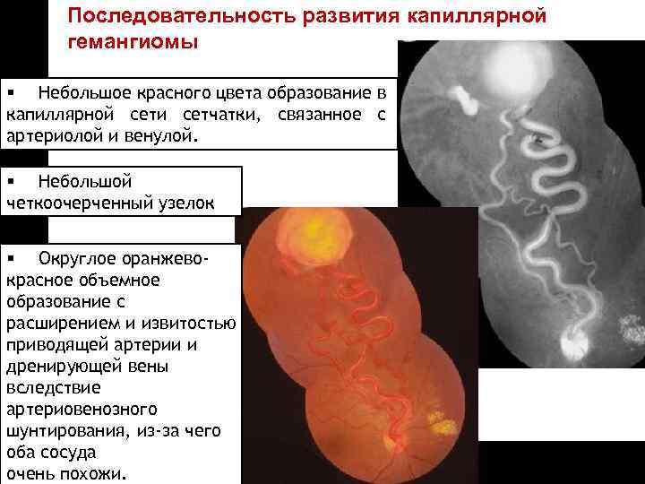 ON TARGET Последовательность развития капиллярной гемангиомы § Небольшое красного цвета образование в капиллярной сети