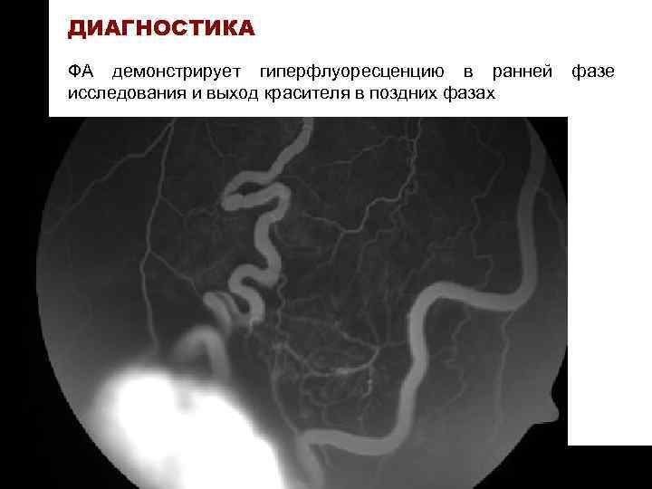 ON TARGET ДИАГНОСТИКА ФА демонстрирует гиперфлуоресценцию в ранней исследования и выход красителя в поздних