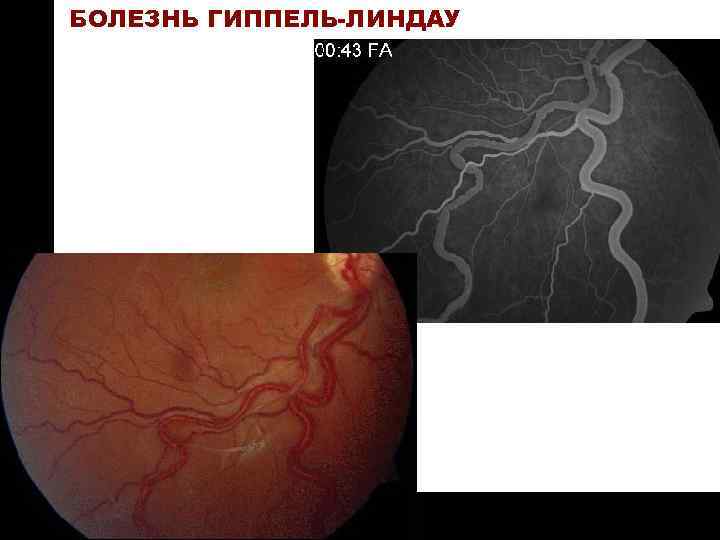 ON TARGET БОЛЕЗНЬ ГИППЕЛЬ-ЛИНДАУ 