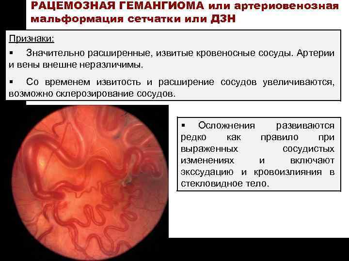 ON TARGET РАЦЕМОЗНАЯ ГЕМАНГИОМА или артериовенозная мальформация сетчатки или ДЗН Признаки: § Значительно расширенные,