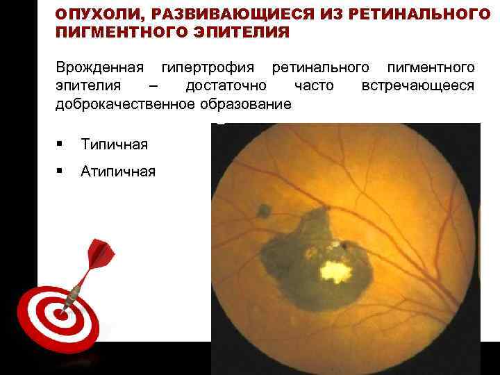 ON TARGET ОПУХОЛИ, РАЗВИВАЮЩИЕСЯ ИЗ РЕТИНАЛЬНОГО ПИГМЕНТНОГО ЭПИТЕЛИЯ Врожденная гипертрофия ретинального пигментного эпителия –