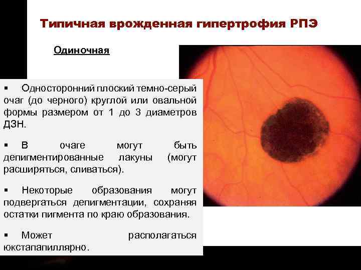 ON TARGET Типичная врожденная гипертрофия РПЭ Одиночная § Односторонний плоский темно-серый очаг (до черного)