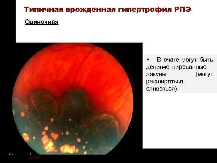 ON TARGET Типичная врожденная гипертрофия РПЭ Одиночная § В очаге могут быть депигментированные лакуны