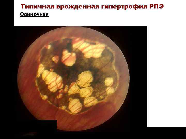 ON TARGET Типичная врожденная гипертрофия РПЭ Одиночная 