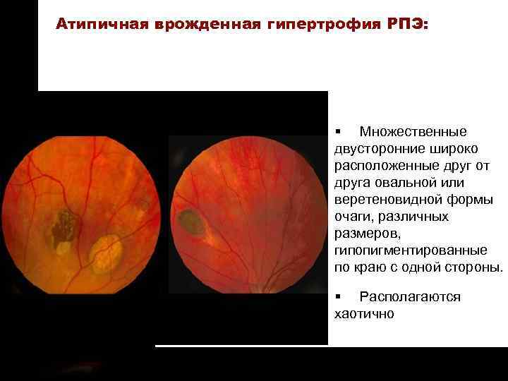 ON TARGET Атипичная врожденная гипертрофия РПЭ: § Множественные двусторонние широко расположенные друг от друга