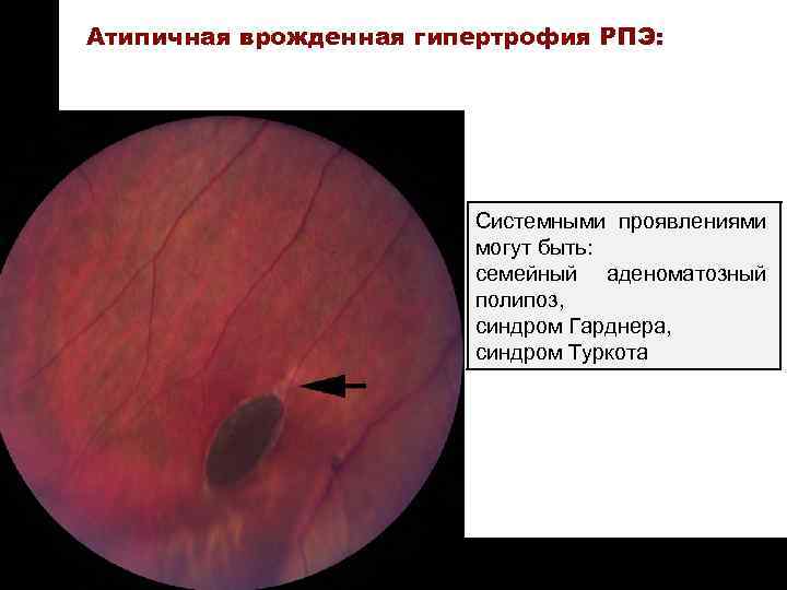 ON TARGET Атипичная врожденная гипертрофия РПЭ: Системными проявлениями могут быть: семейный аденоматозный полипоз, синдром