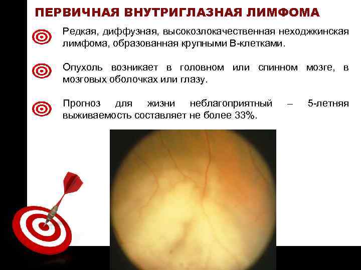 ON TARGET ПЕРВИЧНАЯ ВНУТРИГЛАЗНАЯ ЛИМФОМА Редкая, диффузная, высокозлокачественная неходжкинская лимфома, образованная крупными В-клетками. Опухоль