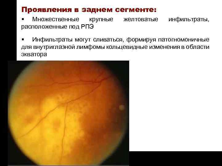 ON TARGET Проявления в заднем сегменте: § Множественные крупные расположенные под РПЭ желтоватые инфильтраты,