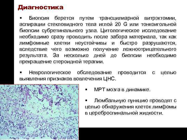 ON TARGET Диагностика § Биопсия берется путем трансцилиарной витрэктомии, аспирации стекловидного тела иглой 20