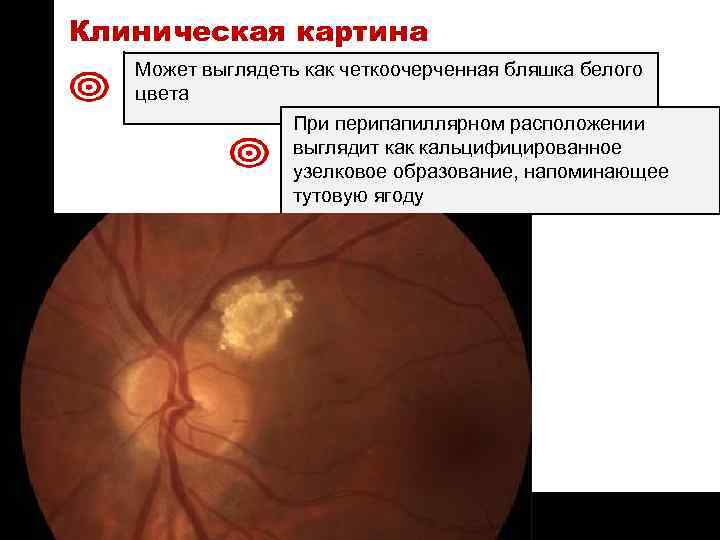 ON TARGET Клиническая картина Может выглядеть как четкоочерченная бляшка белого цвета При перипапиллярном расположении