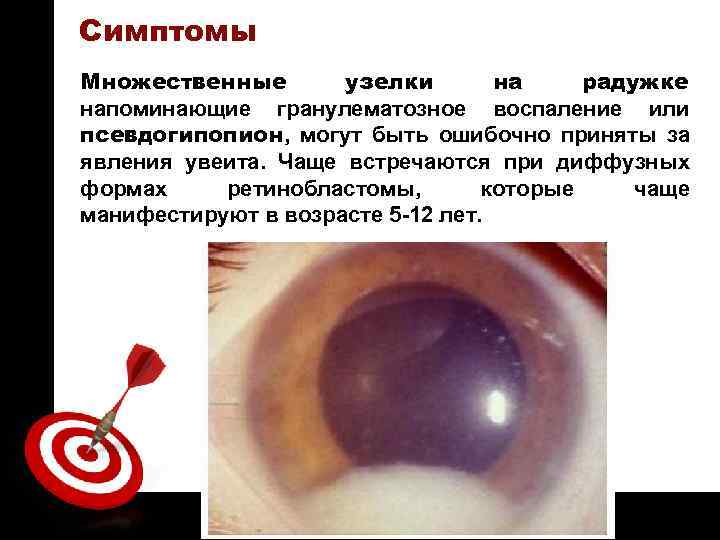 ON TARGET Симптомы Множественные узелки на радужке напоминающие гранулематозное воспаление или псевдогипопион, могут быть