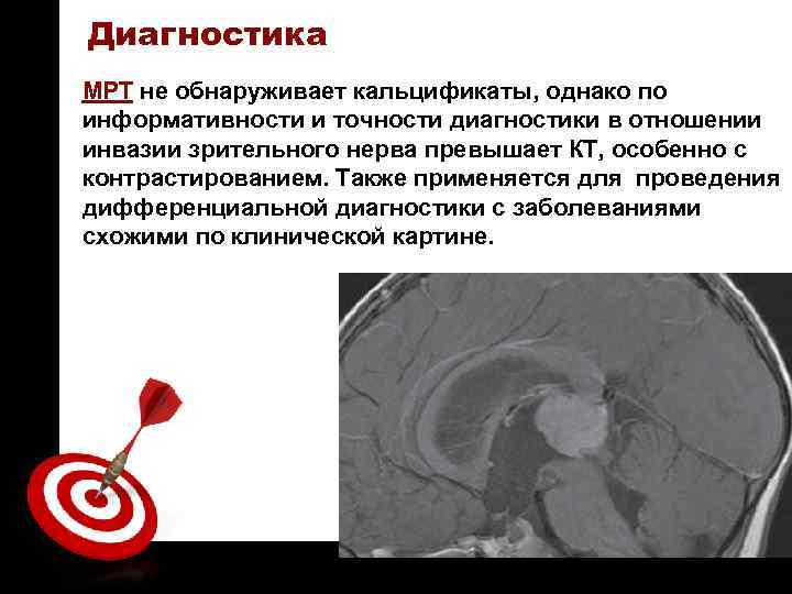 ON TARGET Диагностика МРТ не обнаруживает кальцификаты, однако по информативности и точности диагностики в