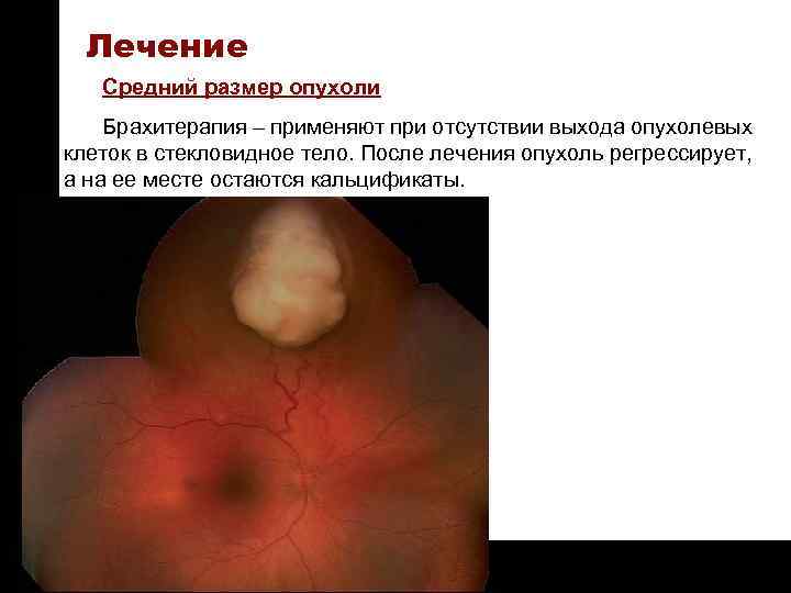 ON TARGET Лечение Средний размер опухоли Брахитерапия – применяют при отсутствии выхода опухолевых клеток