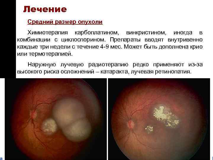 ON TARGET Лечение Средний размер опухоли Химиотерапия карбоплатином, винкристином, иногда в комбинации с циклоспорином.