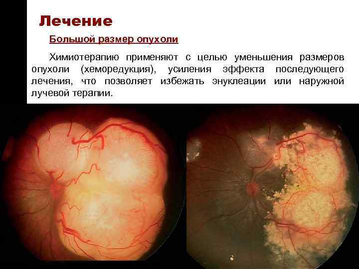 ON TARGET Лечение Большой размер опухоли Химиотерапию применяют с целью уменьшения размеров опухоли (хеморедукция),