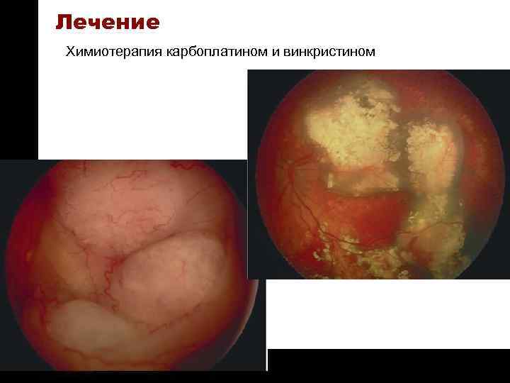 ON TARGET Лечение Химиотерапия карбоплатином и винкристином 