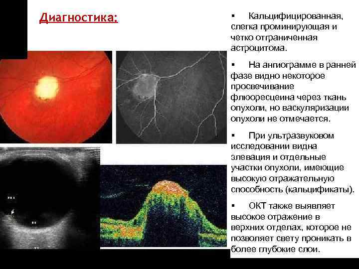 ON TARGET Диагностика: § Кальцифицированная, слегка проминирующая и четко отграниченная астроцитома. § На ангиограмме