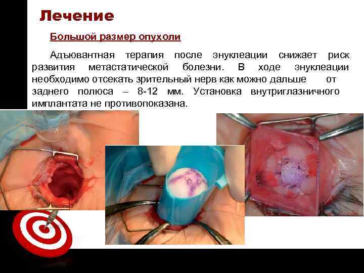 ON TARGET Лечение Большой размер опухоли Адъювантная терапия после энуклеации снижает риск развития метастатической
