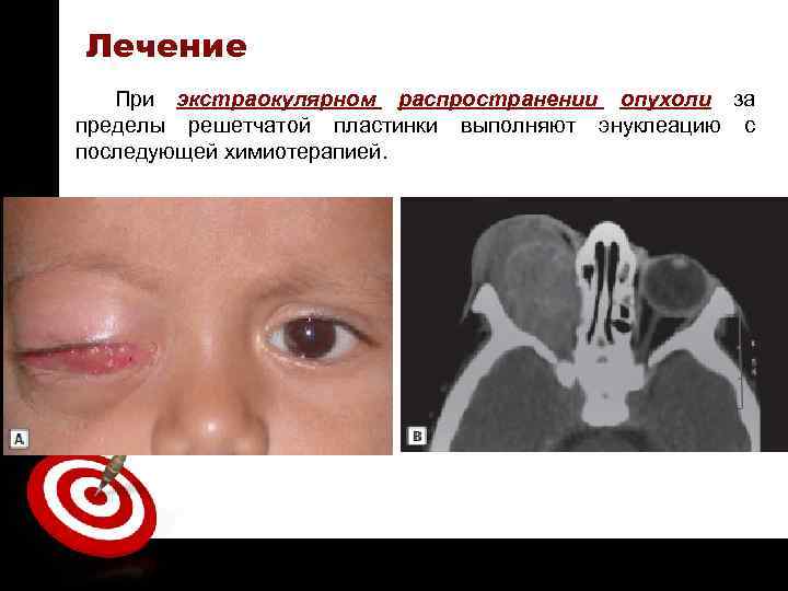 ON TARGET Лечение При экстраокулярном распространении опухоли за пределы решетчатой пластинки выполняют энуклеацию с