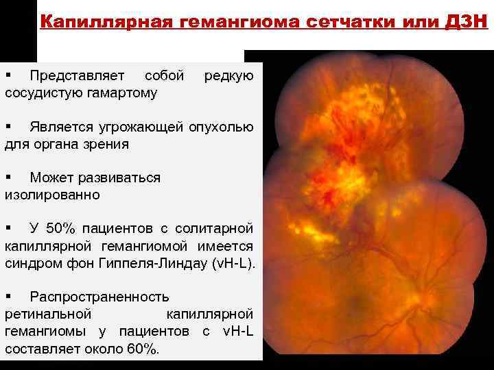 ON TARGET Капиллярная гемангиома сетчатки или ДЗН § Представляет собой сосудистую гамартому редкую §