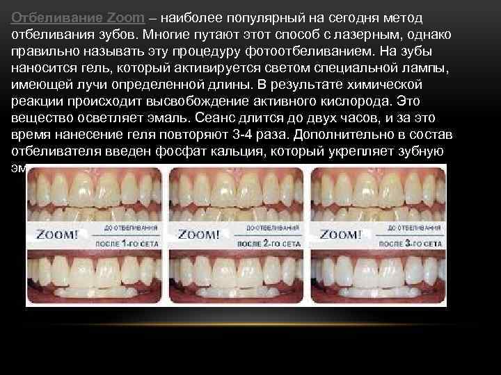 Отбеливание Zoom – наиболее популярный на сегодня метод отбеливания зубов. Многие путают этот способ