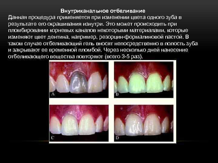 Внутриканальное отбеливание Данная процедура применяется при изменении цвета одного зуба в результате его окрашивания
