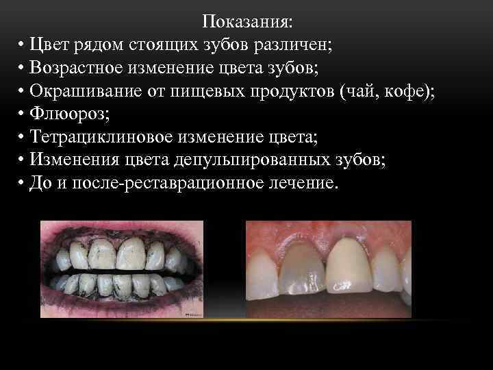 Показания: • Цвет рядом стоящих зубов различен; • Возрастное изменение цвета зубов; • Окрашивание