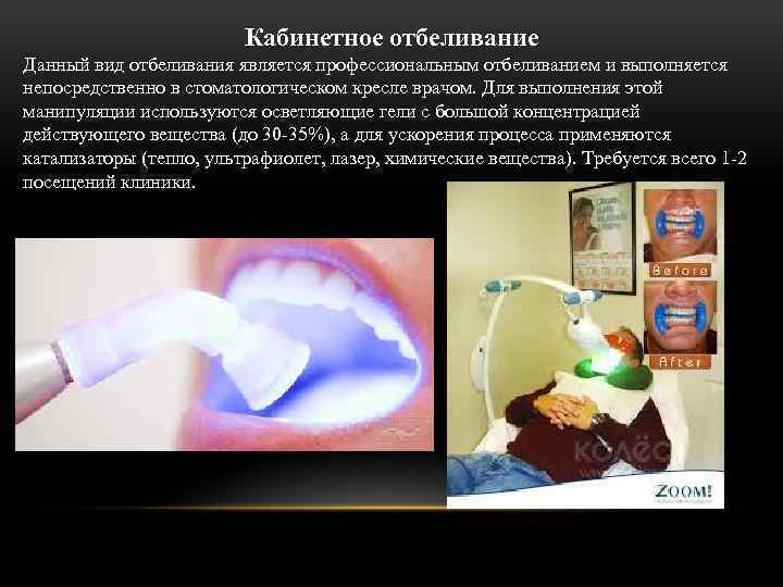 Кабинетное отбеливание Данный вид отбеливания является профессиональным отбеливанием и выполняется непосредственно в стоматологическом кресле