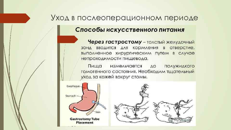 Уход в послеоперационном периоде 