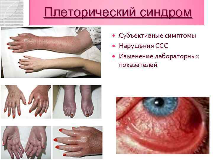 Плеторический синдром Субъективные симптомы Нарушения ССС Изменение лабораторных показателей 