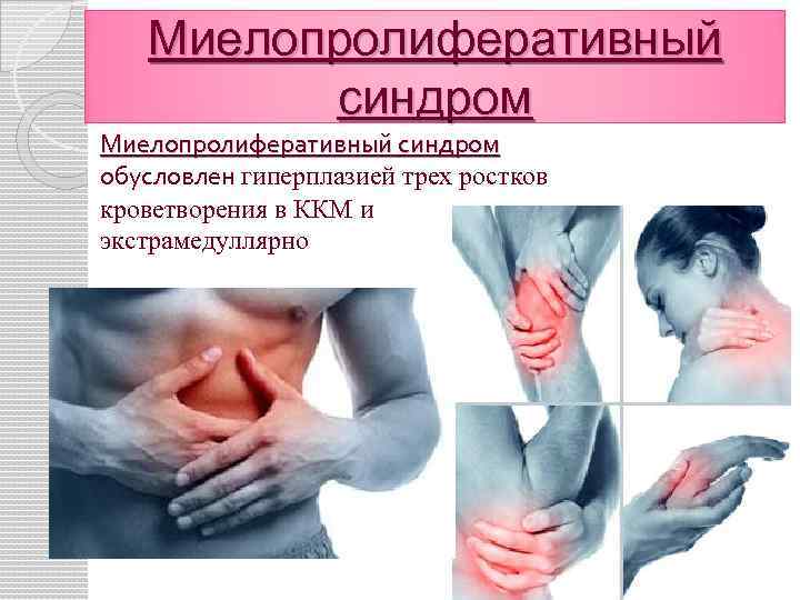 Миелопролиферативный синдром обусловлен гиперплазией трех ростков кроветворения в ККМ и экстрамедуллярно 