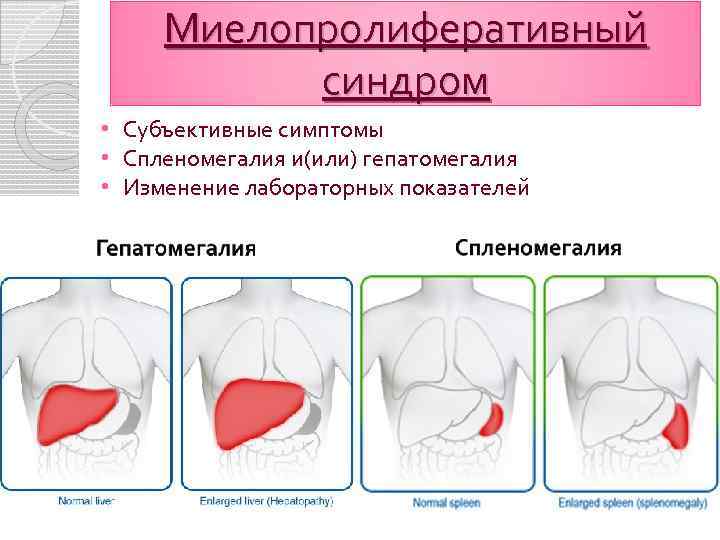 Миелопролиферативный синдром • Субъективные симптомы • Спленомегалия и(или) гепатомегалия • Изменение лабораторных показателей 
