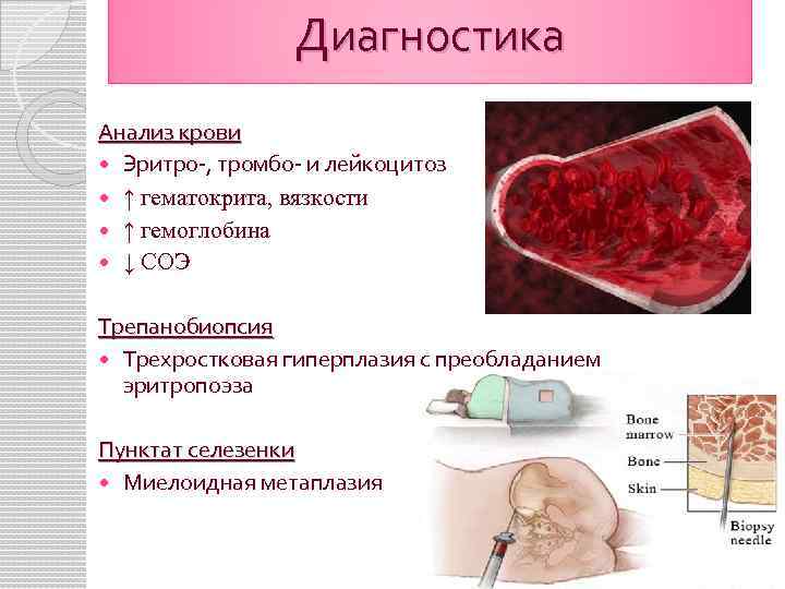 Диагностика Анализ крови Эритро-, тромбо- и лейкоцитоз ↑ гематокрита, вязкости ↑ гемоглобина ↓ СОЭ